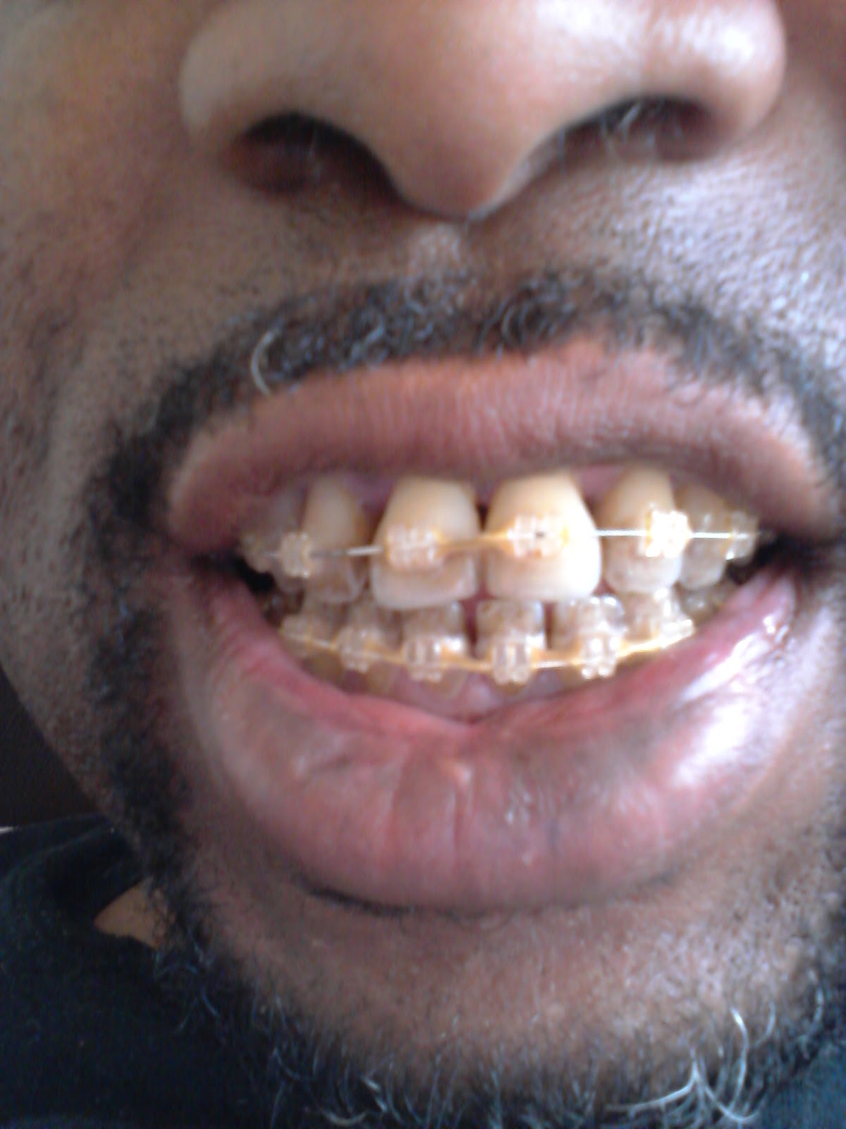 Fifty year old BraceFace